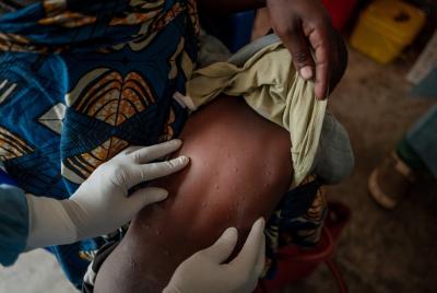The mpox virus is spreading through parts of Africa. (Photo: World Health Organization via X.) The mpox virus is spreading through parts of Africa. (Photo: World Health Organization via X.)