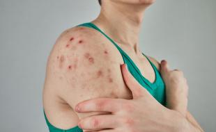 Measles cases are on the rise across Canada and the U.S. (Photo: Andrej Lisakov via Unsplash.)